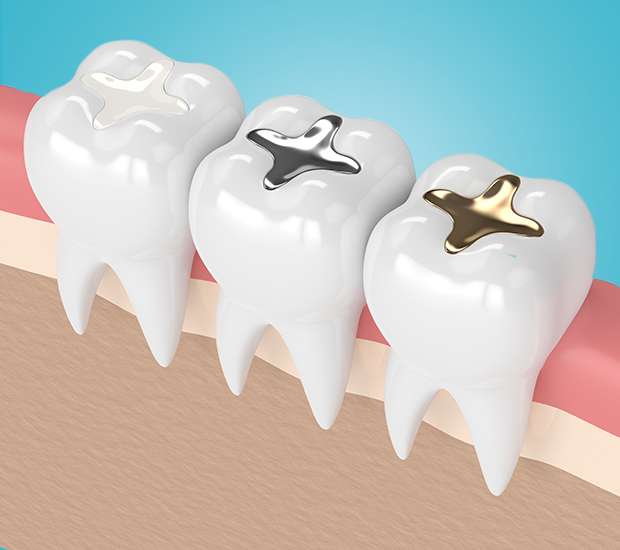 Maywood Composite Fillings