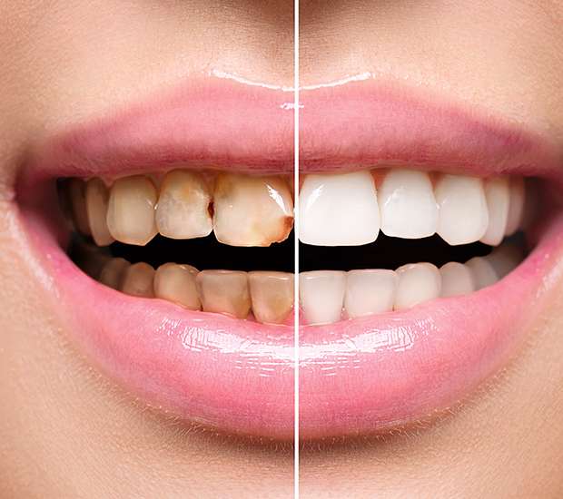Maywood Dental Implant Restoration