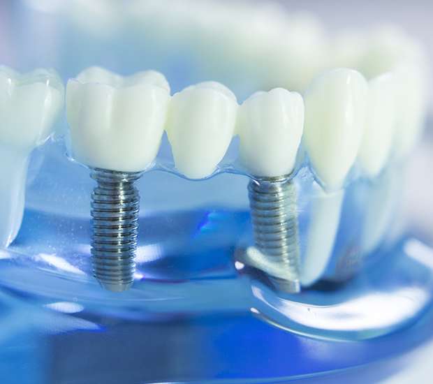 Maywood Dental Implants