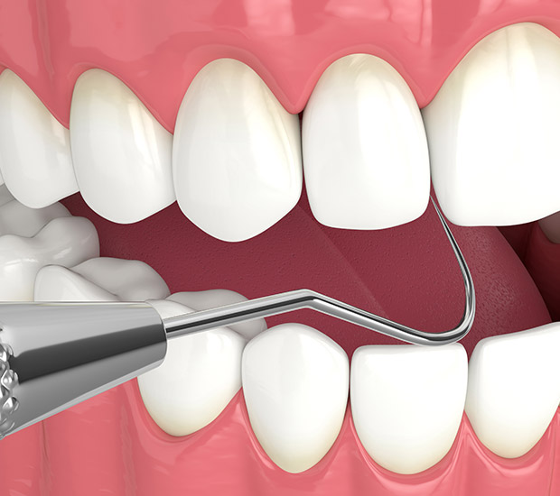 Maywood Periodontal Probing