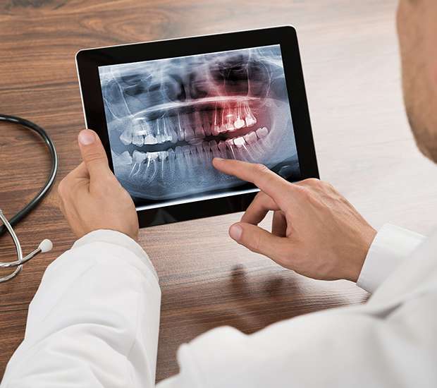 Maywood Types of Dental Root Fractures
