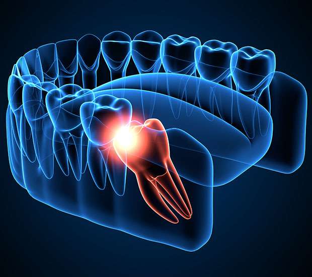 Maywood Wisdom Teeth Extraction